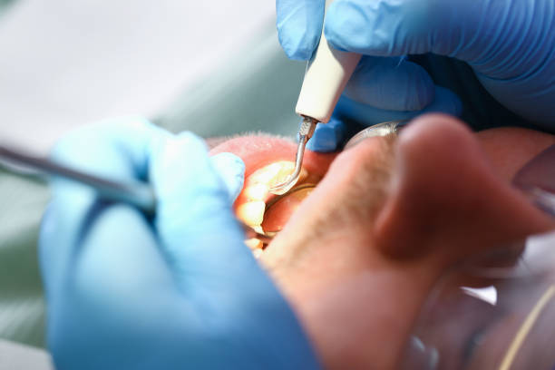 Best Broken or Cracked Tooth Emergency Dentist in Irvington, NY