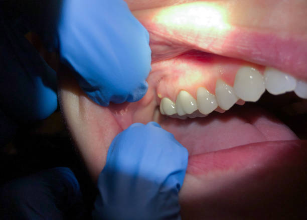 Best Emergency Dentist for Knocked-Out Tooth in Irvington, NY